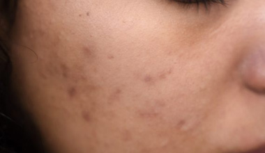 What Is Fungal Acne And How Can You Treat It?