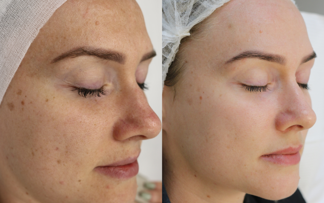 The Benefits of Cosmelan Treatment : Unveiling the Secret to Flawless Skin
